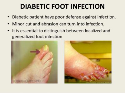 diabetic-foot-disease-26-638